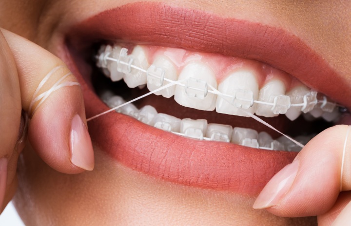 Brakets de zafiro
