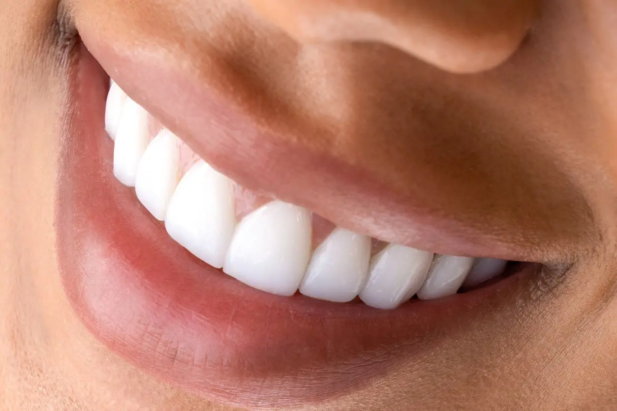 Limpieza dental